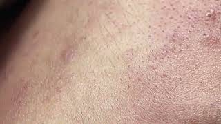 Acne on skin  Remove nose pimples  Acne Treatments Mai Ngoc 💕💕💕 [upl. by Nayt]