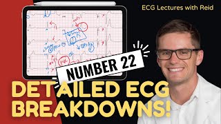 EKG Test Yourself  ECG Case Study 22 [upl. by Bedwell]