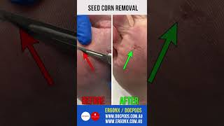 Seed corn removal [upl. by Villiers]