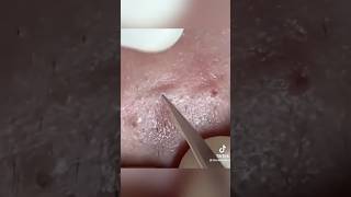 Élimination de Points Noirs Expressblackheads pimple acne [upl. by Darrow]