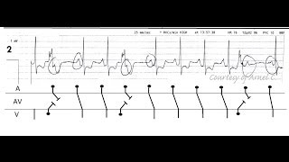 Pseudosecond Degree AV Block [upl. by Ellennahs741]