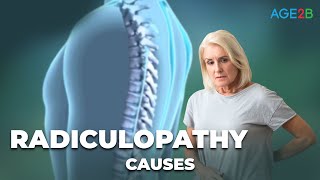 Causes and Treatment Options for Radiculopathy  How To Overcome Radiculopathy [upl. by Anirehtak475]