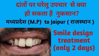 मध्यप्रदेश राज्य से आये पेशेंट Smile design treatment  दांतो पर घरेलू उपचार से हो रहा है नुकसान [upl. by Eleni902]