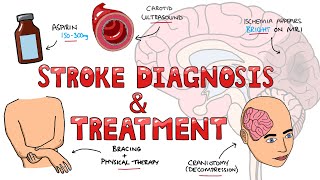 Stroke Diagnosis and Treatment  Acute and Long Term Treatment of Ischemic and Hemorrhagic Stroke [upl. by Ellened]