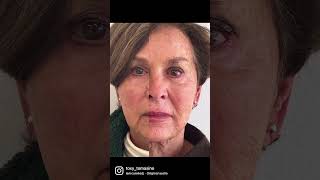 Dramatic Wrinkle Reduction with Botox Before amp After aobmedspa medspa botox [upl. by Paige]