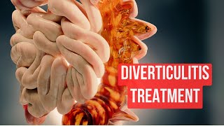 How To Treat Diverticulitis in 2024 [upl. by Nichy]