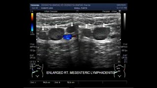 Ultrasound Video showing Mesenteric lymphadenitis enlarged mesenteric lymph nodes [upl. by Erlin942]