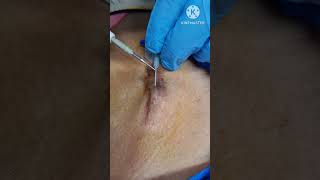 Intra tissue electrodesiccation treatment for keloid scar Contact 9700020802 [upl. by Ennovyahs92]