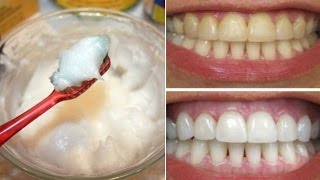 How To Whiten Your Yellow Teeth Naturally At Home दांत चमकानाTooth Whitening [upl. by Anelagna96]