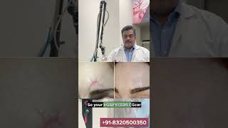 CO2 Fractional Laser Treatment  Keloid Scars  Dr Ashutosh Shah  Elegance Clinic  Surat [upl. by Kenaz]