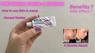 Skin A Cream Review  Acne Treatment at home  How to Use Tretinoin  Tretinoin Cream [upl. by Katy]