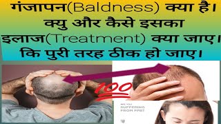 गंजापनBaldness क्या है।क्यु और कैसे इसका इलाजTreatment क्या जाए। कि पुरी तरह ठीक हो जाए। [upl. by Callas557]