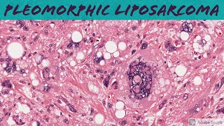 Pleomorphic Liposarcoma 5Minute Pathology Pearls [upl. by Howlan811]