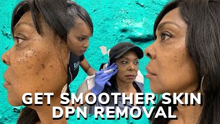 DPN removal for smoother skin [upl. by Heyman]