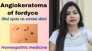 Angiokeratoma of fordyce  red bumps on scrotal skin  symptomscause amp Homeopathic medicine hindi [upl. by Resee]