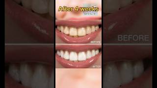 வீட்டில இருந்தே பற்கள் வெள்ளை ஆகனுமாTeeth whitening shortsfacts dentaldoctortrendinghealth [upl. by Assiren]