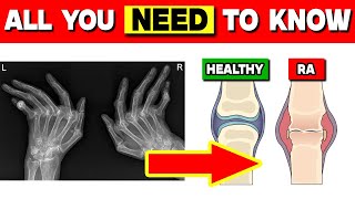 Rheumatoid Arthritis What You Need to Know [upl. by Darwin]