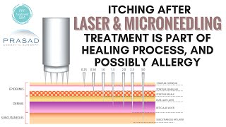 Why Itching is Part of the Healing Process of Facial Microneedling and Laser Resurfacing [upl. by Ladnik]