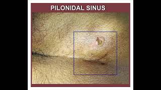 PILONIDAL SINUS [upl. by Daveda468]