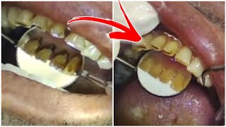 Smokers teeth cleaning  scaling [upl. by Llenrub]