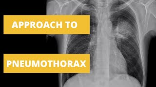 Approach to Pneumothorax  How to Read a Chest X Ray [upl. by Atte449]