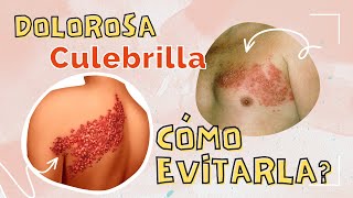 👩‍⚕️Cómo TRATAR la CULEBRILLA o HERPES ZOSTER y cómo evitar el DOLOR 😖 DESPUÉS de tenerla [upl. by Eirak554]