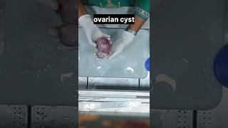 Ovarian cyst  histopathology ovariancyst cyst  ovariancancer histology [upl. by Sair]