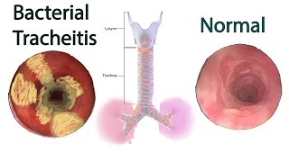 Bacterial Tracheitis  Symptoms causes and treatment [upl. by Devaney]