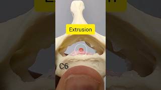 Cervical Disc Herniation Takes Time anatomy [upl. by Carlstrom459]