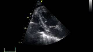 CHRONIC PERICARDITIS with thickening of the pericardium [upl. by Robinetta217]