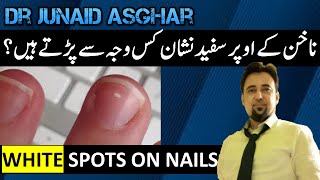 What White Spots on your Nails Tell you  Dr Junaid Asghar [upl. by Dyolf]