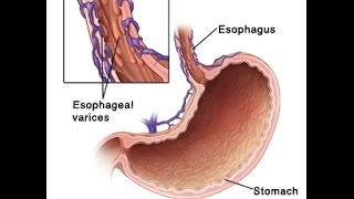 Esophageal Varices [upl. by Onibas251]