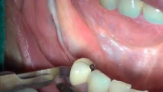 Apical repostioned flap [upl. by Malti]