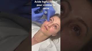 L’acide hyaluronique pour effacer les cernes creux  Dr Raspaldo cernes medecineesthetique [upl. by Erdeid522]