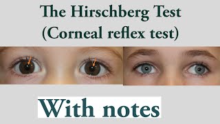 Hirschberg test Hirschberg corneal reflex testSquint lecture 10 [upl. by Berti]