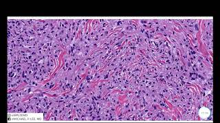 Juvenile Xanthogranuloma JXG Dermpath Made Easy [upl. by Bazil]