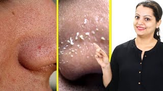 3 असरदार उपाय ब्लैकहेड्स और वाइटहेड्स को हटाने के लिए  3 effective remedy for Blackhead amp Whitehead [upl. by Arianna]