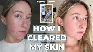 Adapalene Gel amp Benzoyl Peroxide transformation  skincare routine  HOW I CLEARED MY SKIN [upl. by Nahtnoj954]