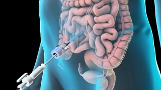 Laparoscopic Lysis of Abdominal Adhesions 2011 [upl. by Fiona651]