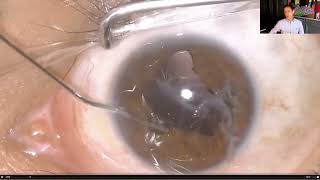 Lecture Secondary Intraocular Lens IOLs in Aphakia [upl. by Lucinda655]