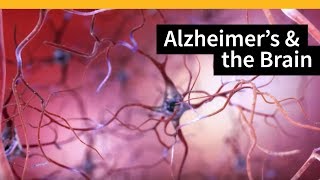 How Alzheimers Changes the Brain [upl. by Asihtal]