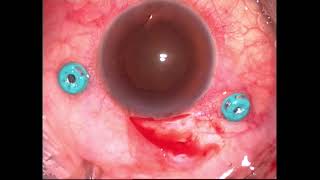 Iron foreign body removal in an eye with siderosis [upl. by Inavoj]