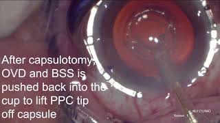 Dr Vance Thompson ZEPTO® Capsulotomy Visual Axis Centration [upl. by Hesper]