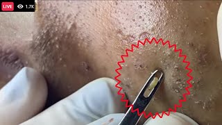 Cystic Acne pimples amp Blackheads Extraction On face Acne Treatment part  Most satisfying face HD [upl. by Secnarfyram]