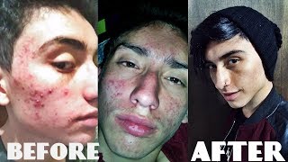 ELIMINA EL ACNE CON ISOTRETINOINA  Me curo el acne 100 [upl. by Niwre]