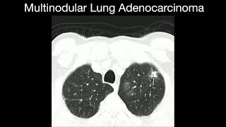 Multinodular Lung Adenocarcinoma [upl. by Neuburger]