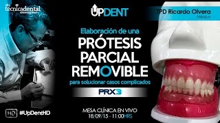 Elaboración de una Prótesis Parcial Removible para solucionar casos complicados [upl. by Assenna]