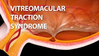 Vitreomacular Traction Syndrome [upl. by Yenahteb955]