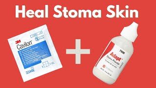 Healing Ostomy Skin Irritations  Crusting Technique quick amp simple  StomaCare [upl. by Milon]