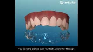 What is Invisalign [upl. by Naut901]